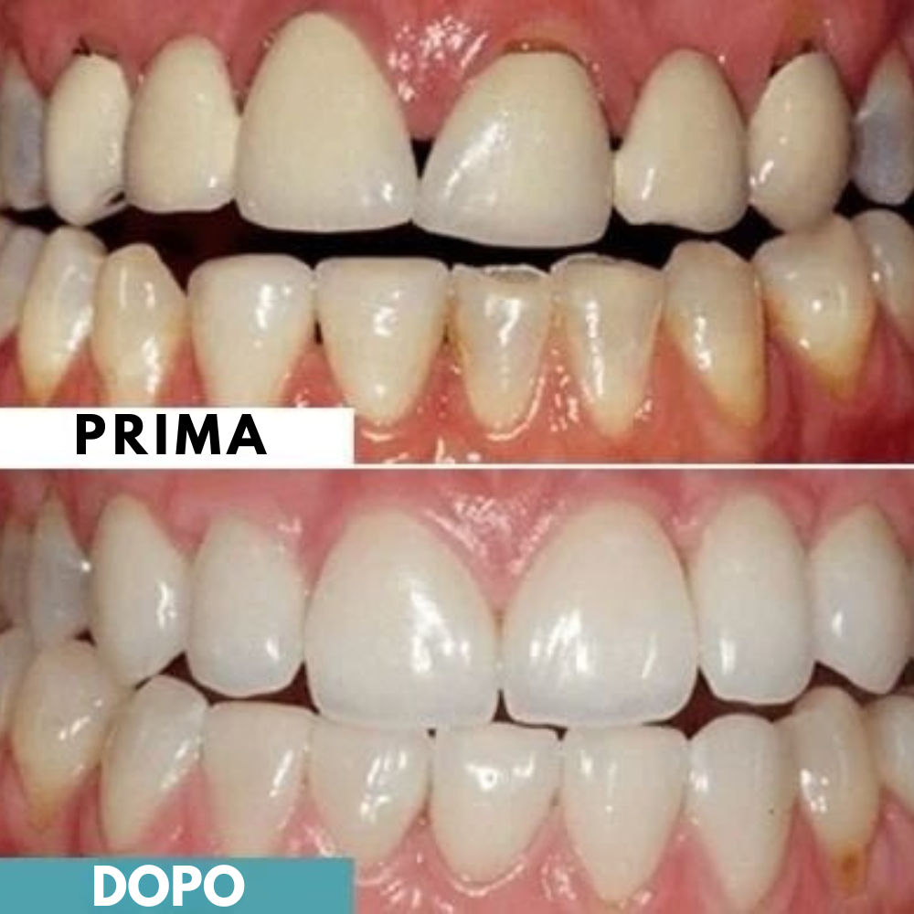 Lumident - 18 Gomme da Masticare Rimineralizzanti contro carie e gengive infiammate (Gusto Menta)