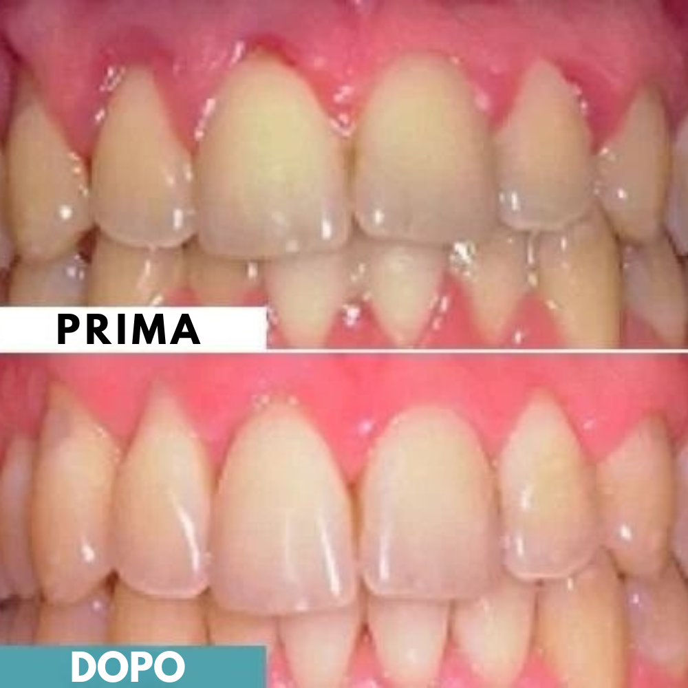 Lumident - 18 Gomme da Masticare Rimineralizzanti contro carie e gengive infiammate (Gusto Menta)